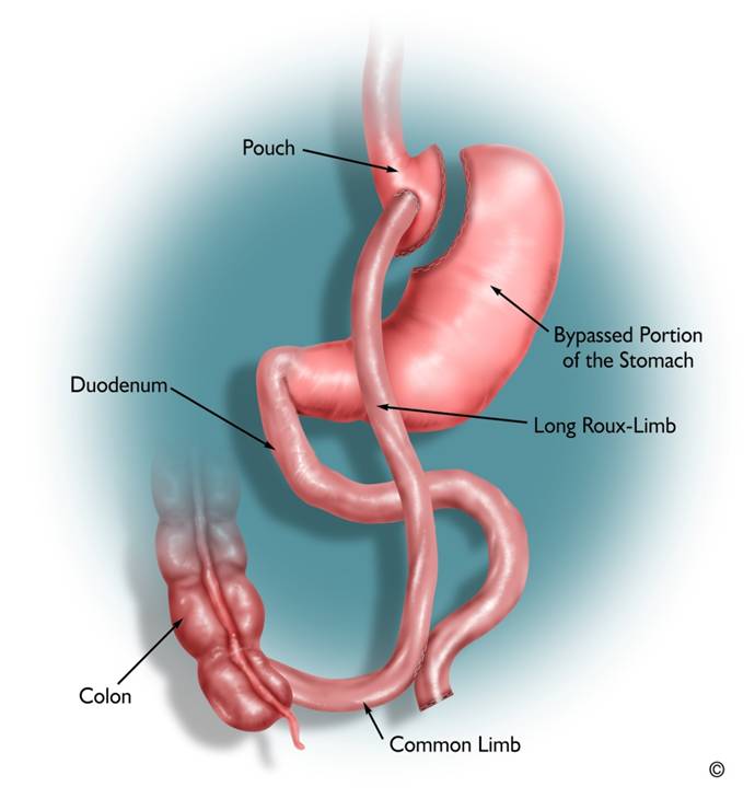 gastric bypass surgery New York