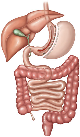 SleeveGastrectomy_web