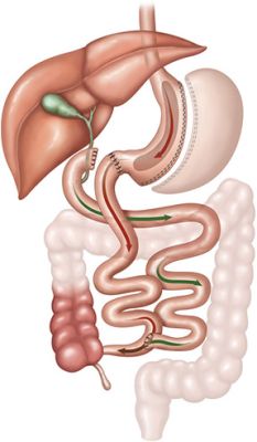 Duodenal Switch Surgery