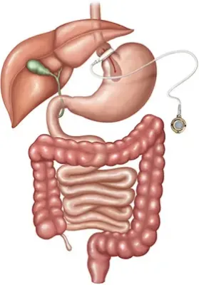 Lap-Band Surgery in New York, NY