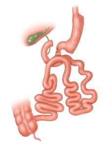 SIPS Procedure