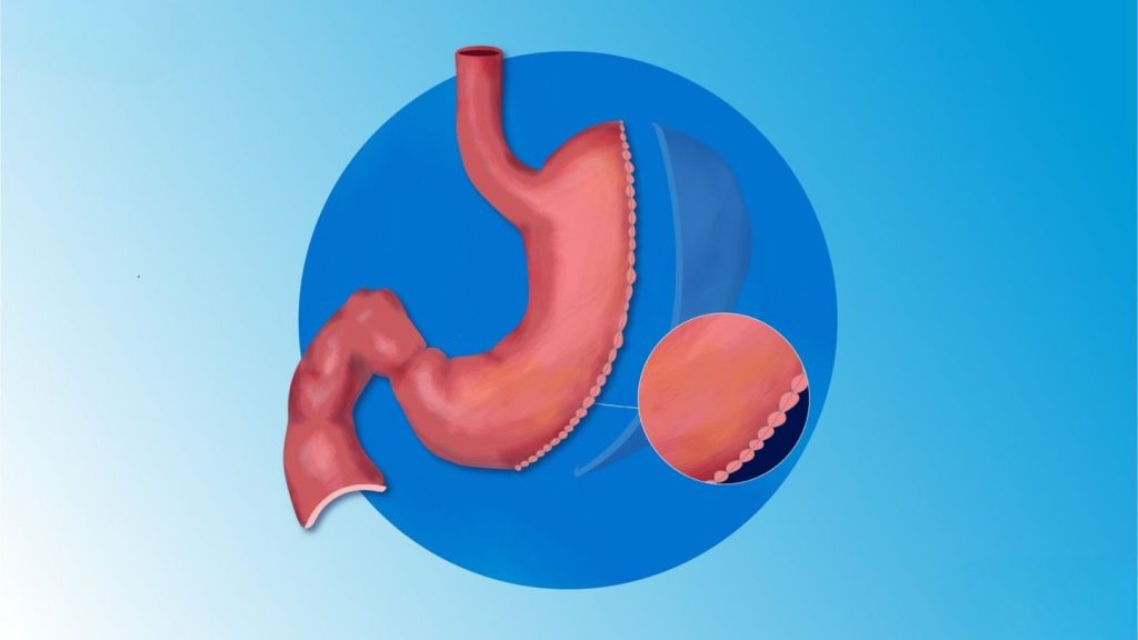 Comparing Gastric Bypass to Other Bariatric Procedures