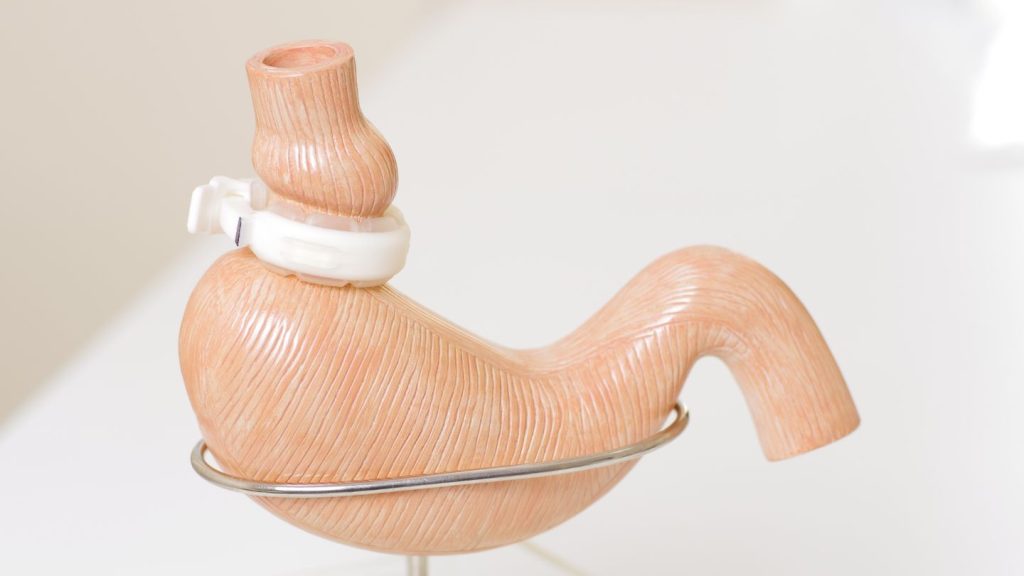 Types of Bariatric Revision Surgeries
