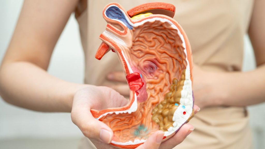 What Happens to the Stomach in a Gastric Sleeve?