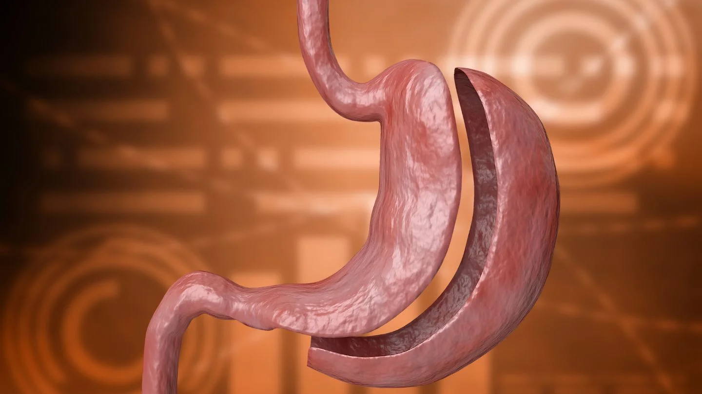 Illustration Of Gastric Sleeve Surgery Procedure And Stomach Size Reduction